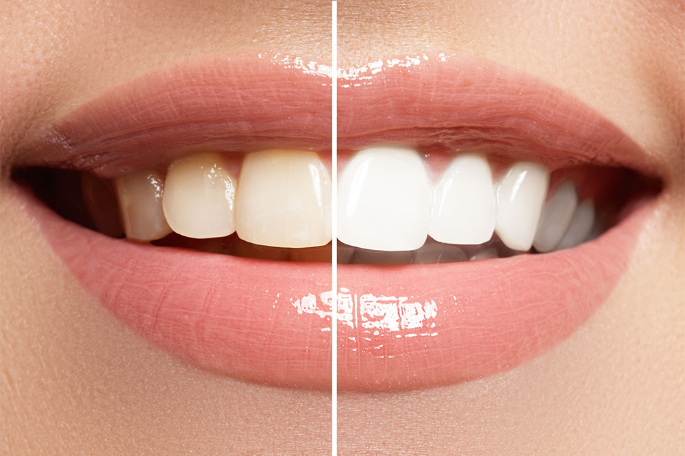 6 Possible Complications of Teeth Whitening