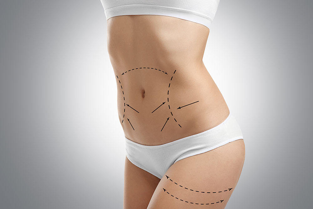 Types of Plastic Surgeries for Stretch Marks