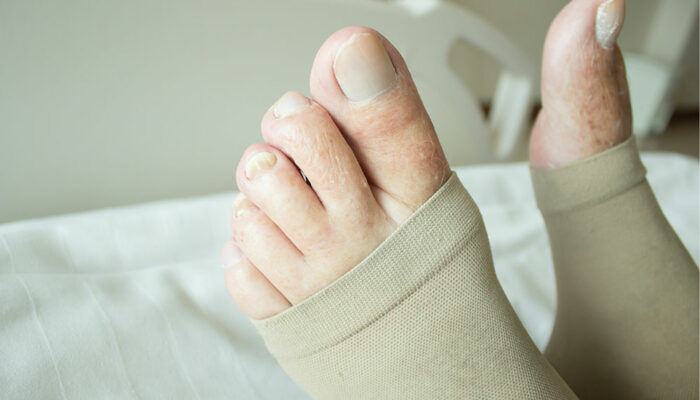 DVT Compression Stockings – How They Work, Types, and Benefits