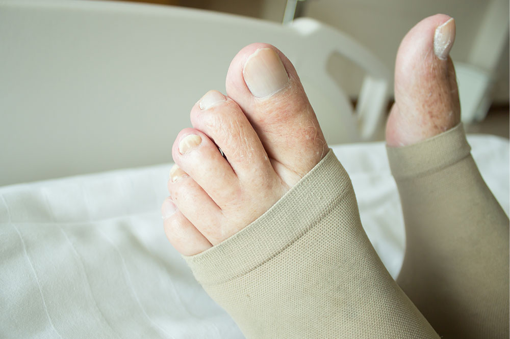 DVT Compression Stockings – How They Work, Types, and Benefits