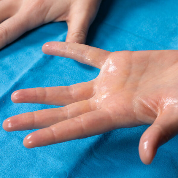Symptoms and Diagnosis of Hyperhidrosis