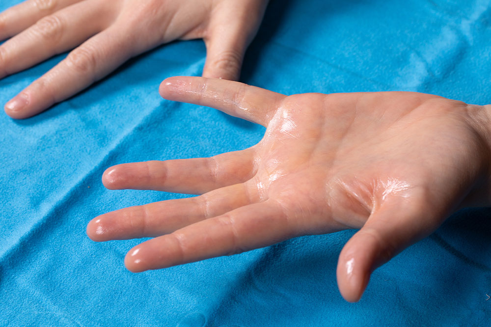 Symptoms and Diagnosis of Hyperhidrosis